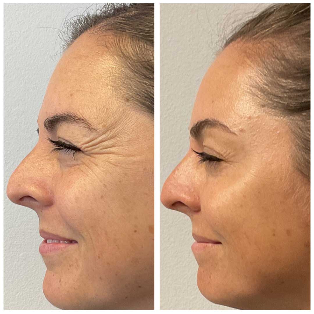 Crow's Feet Treatment - Botox/Dysport