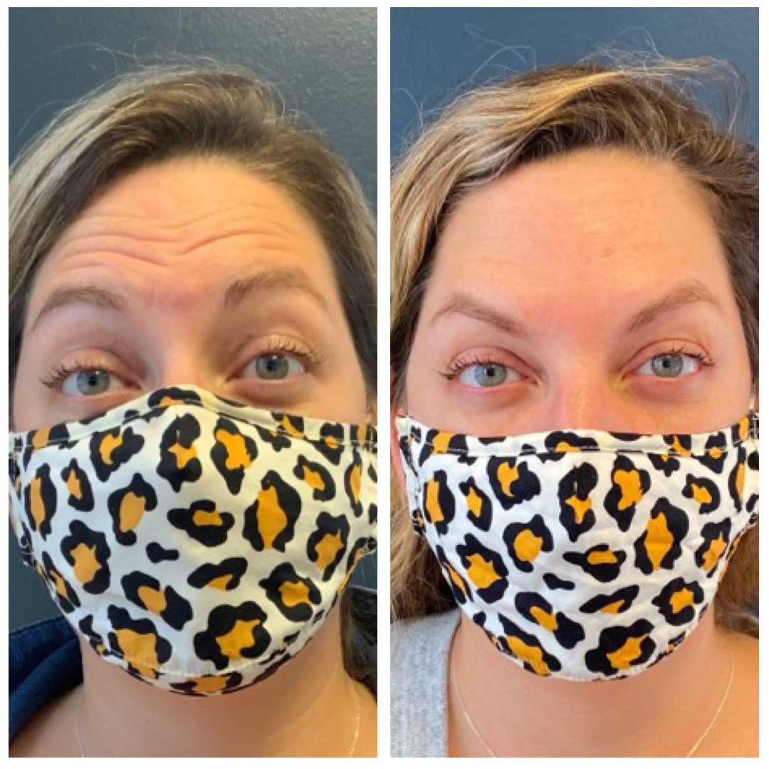 Frown Lines, Forehead, & Crows Feet treatment - Botox/Dysport