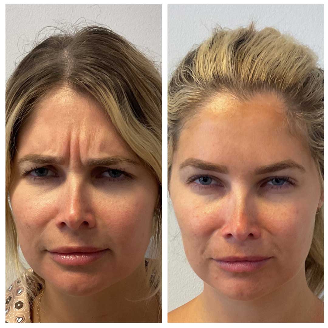 Frown Lines, Forehead, & Crows Feet treatment - Botox/Dysport
