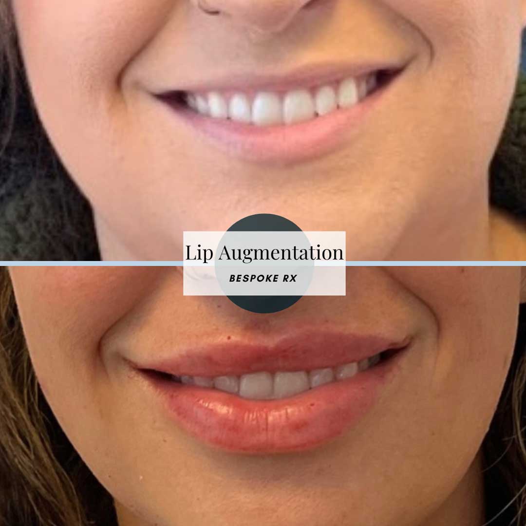 Lip Filler - 5 treatments over 20 months