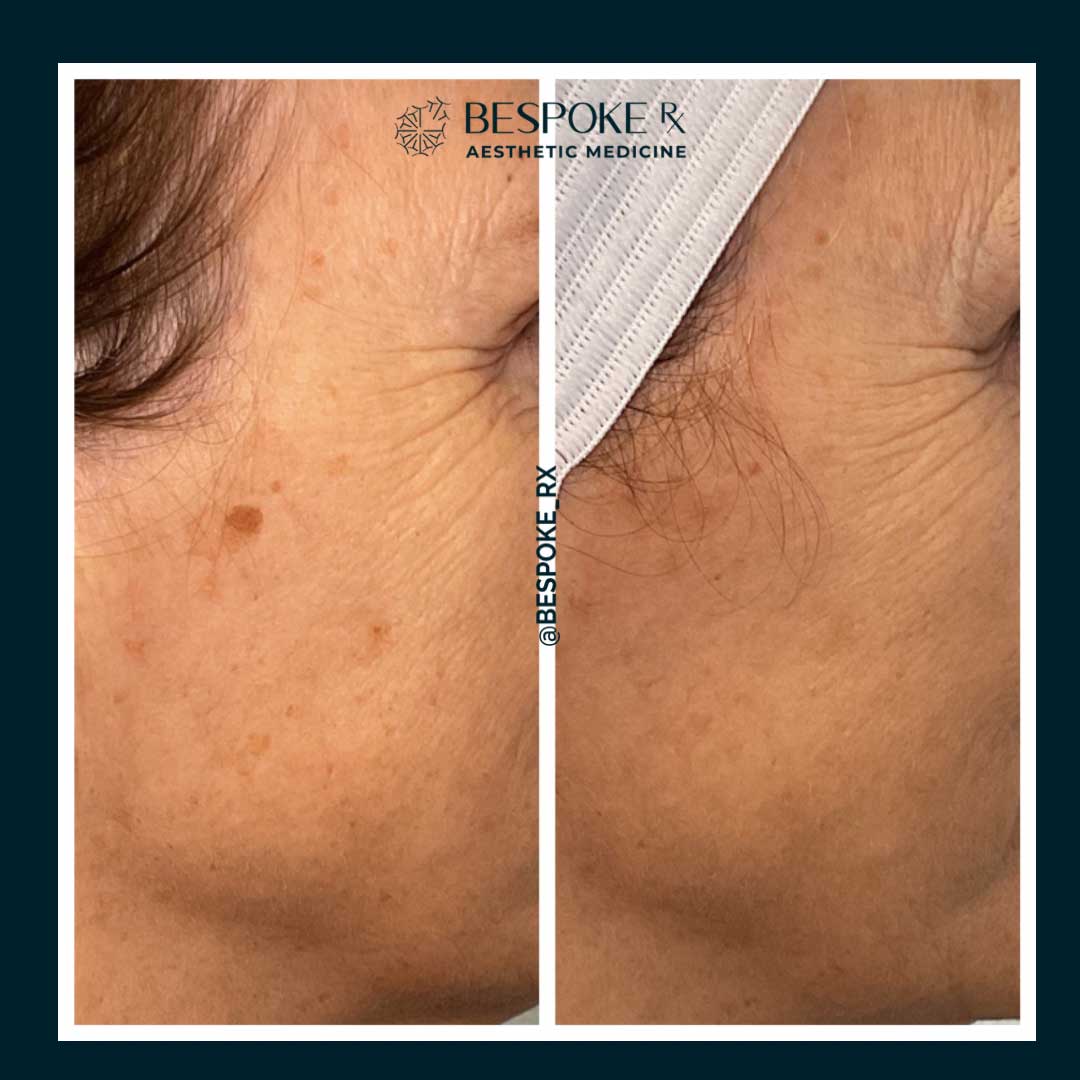 Lumecca IPL Treatment
