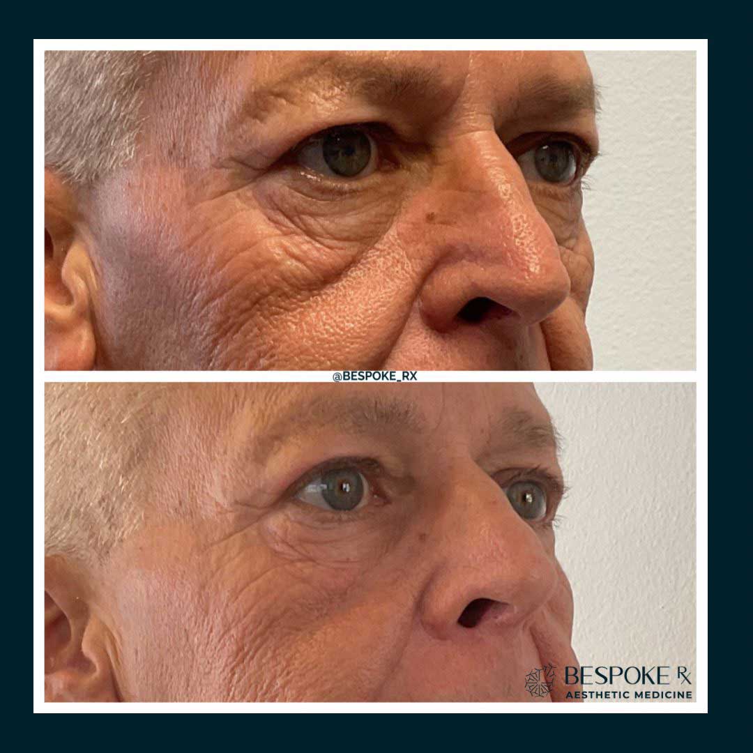 Morpheus8 Treatment