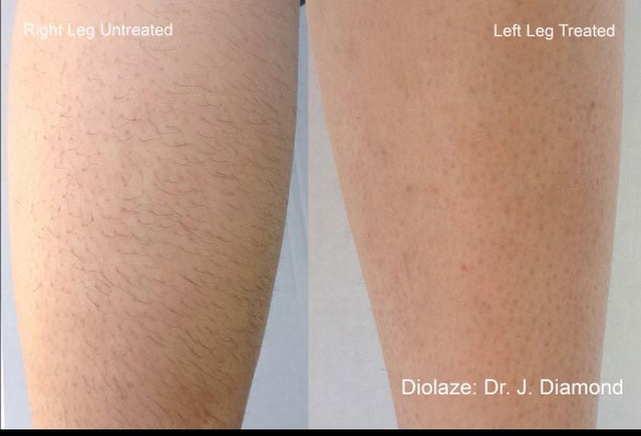 Diolaze Hair Removal Treatment
