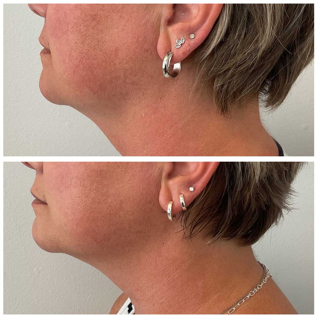 Sculptra Treatment 1