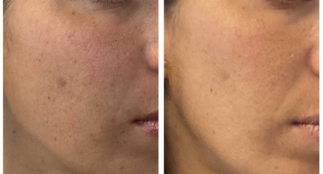 PRX Treatment 2