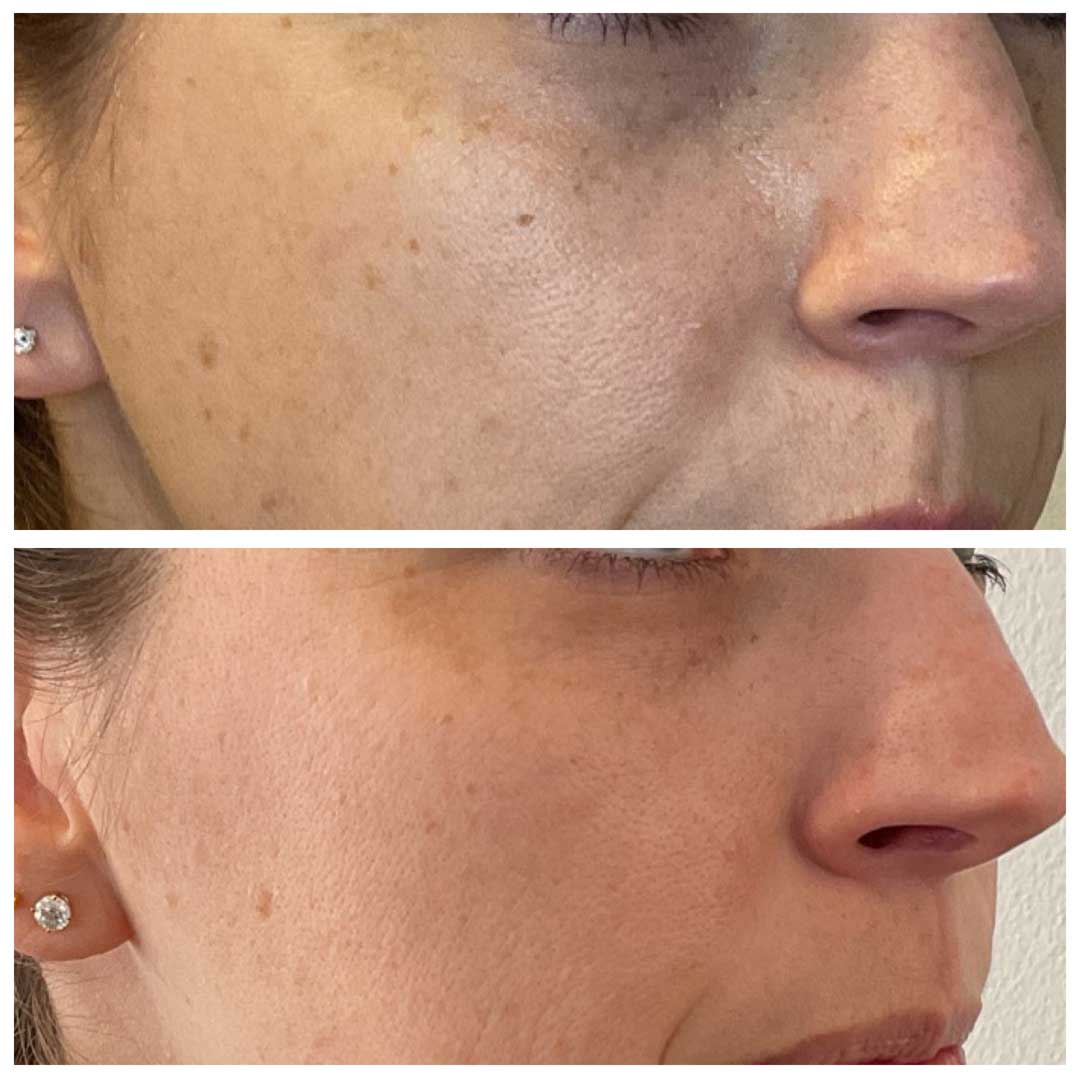 Lumecca IPL Treatment 2