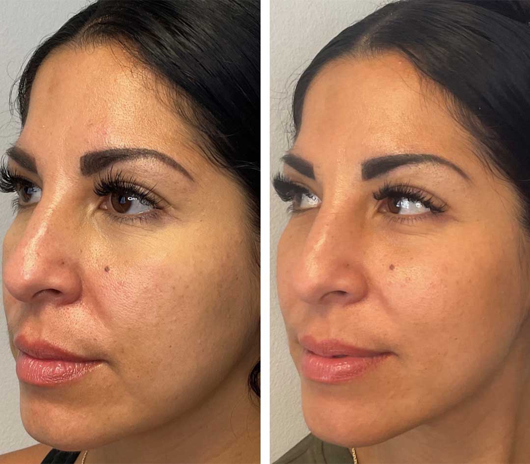 Sculptra Treatment 2