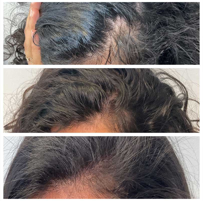 Hair Restoration Treatment 1