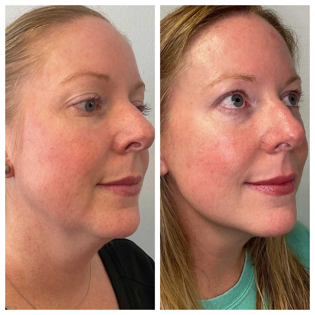 Combined Morpheus & Sculptra Treatment