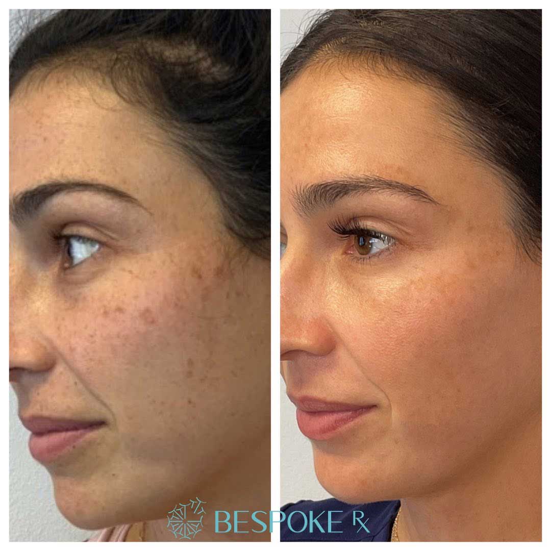 Hyperpigmentation Treatment 1