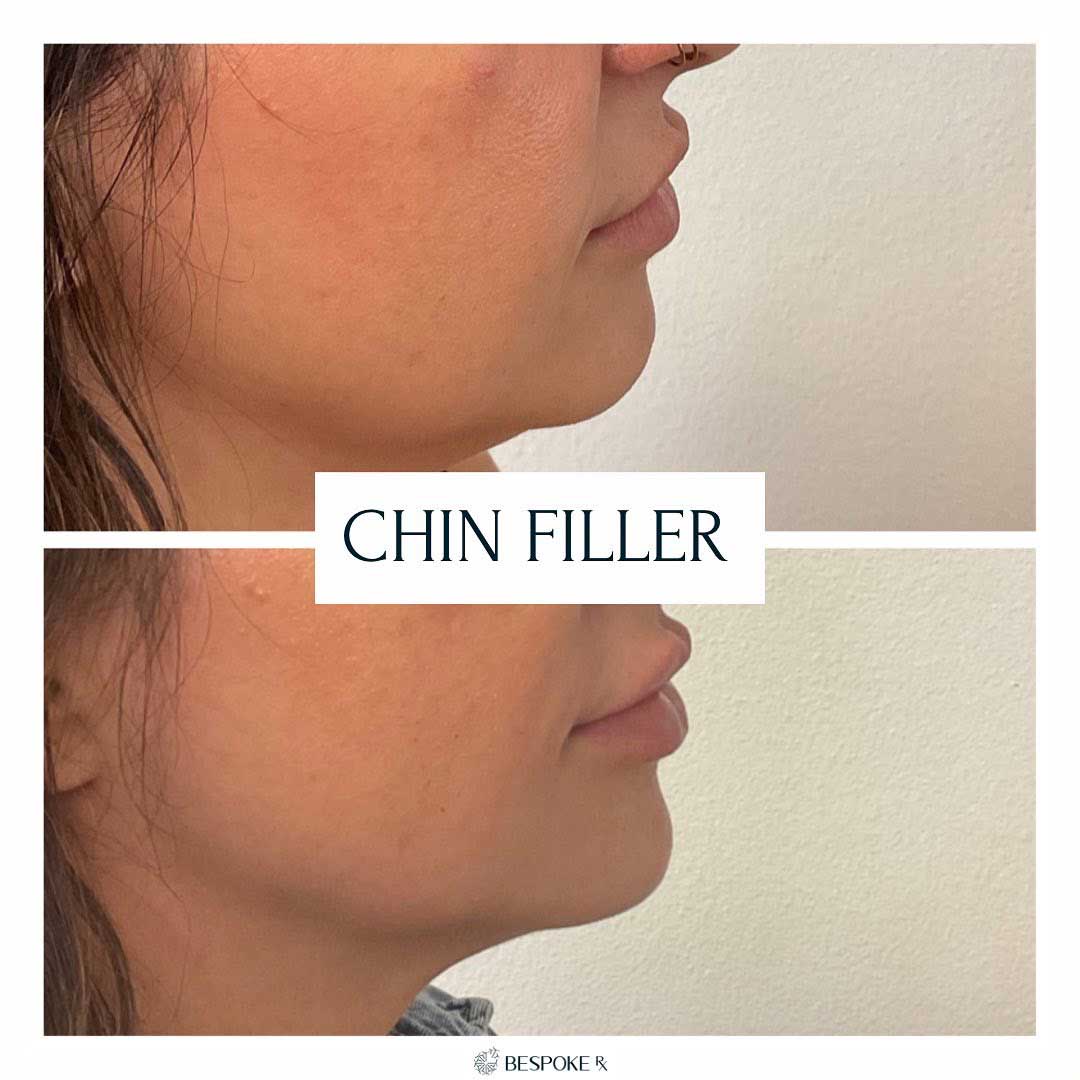 Chin Treatment 1