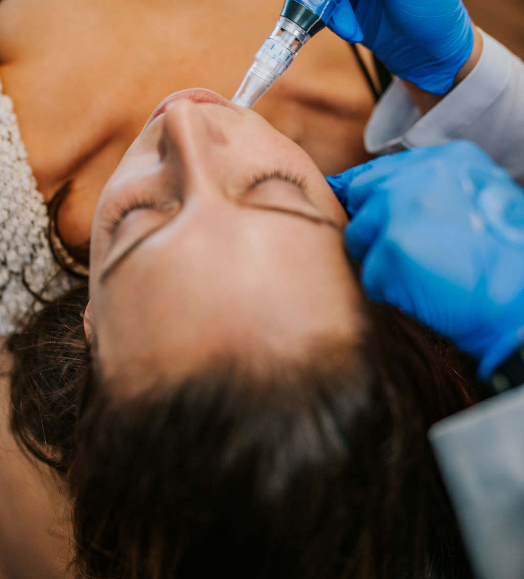 Microneedling