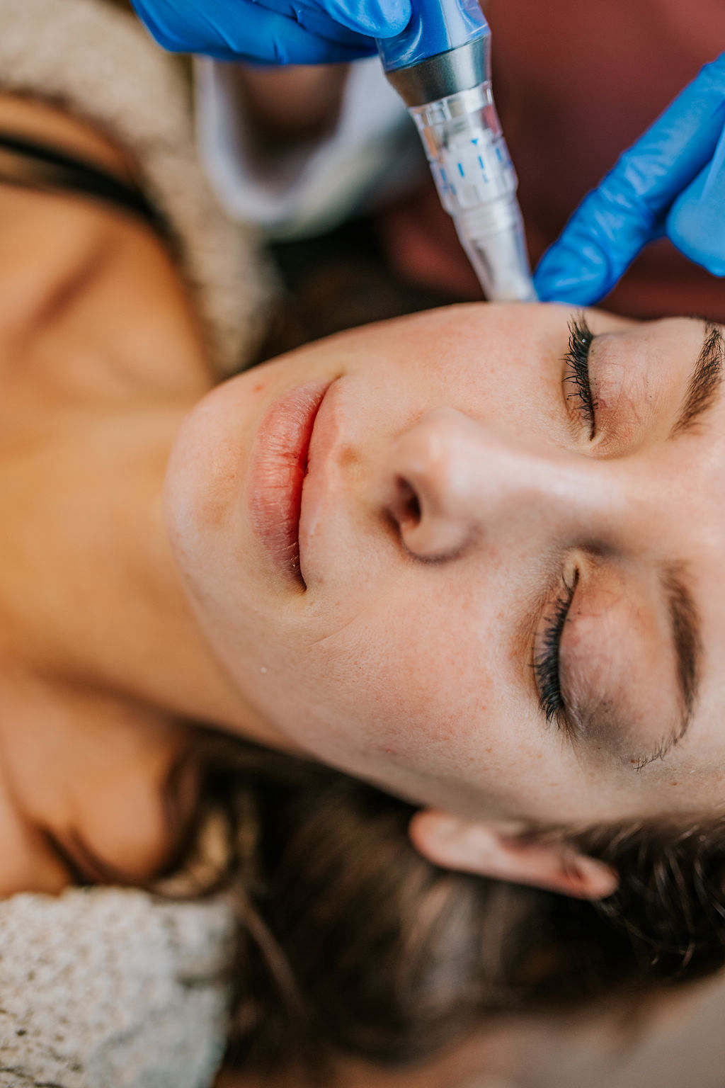 Am I a Candidate for Microneedling?