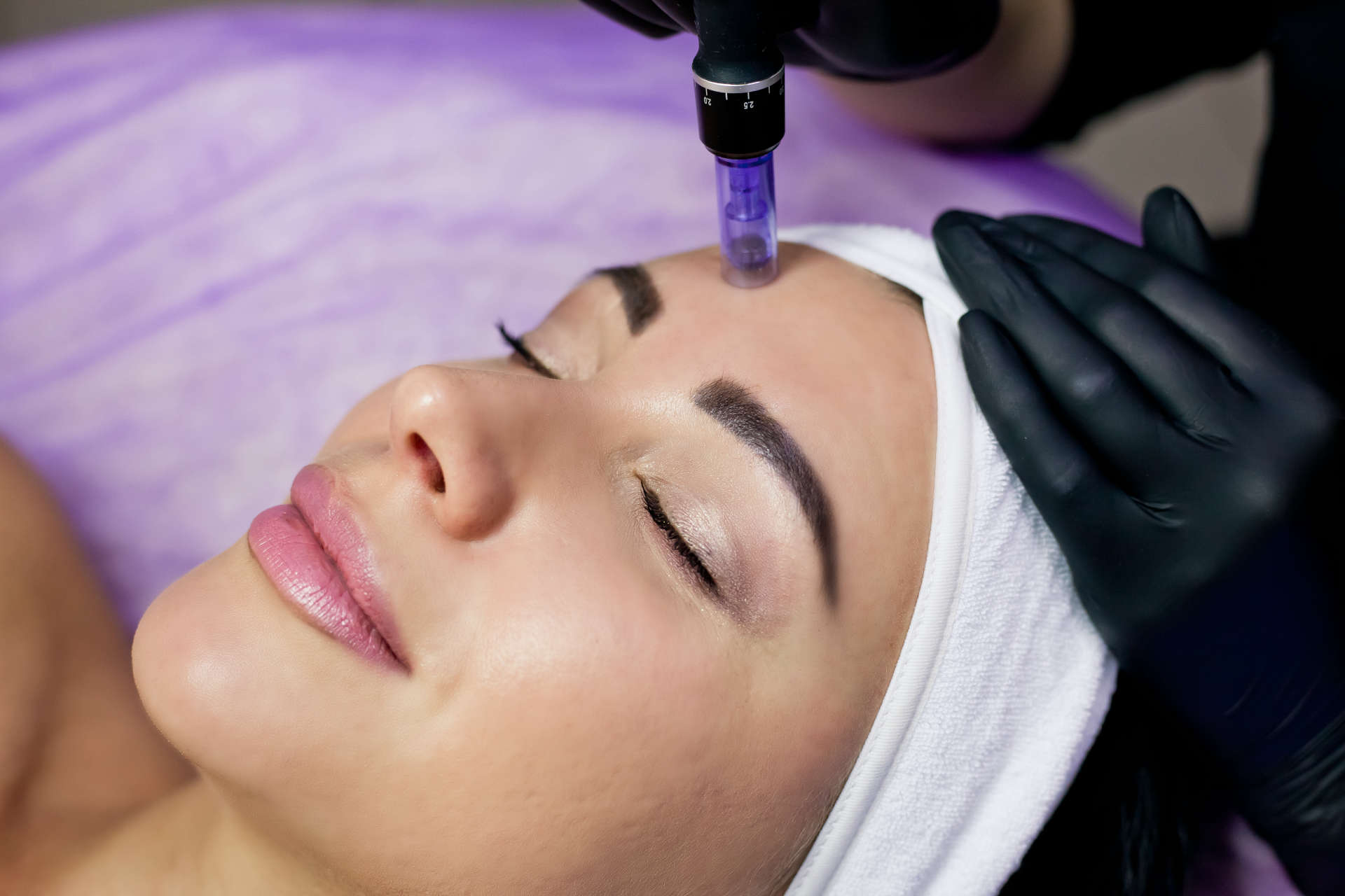 Microneedling with PRF