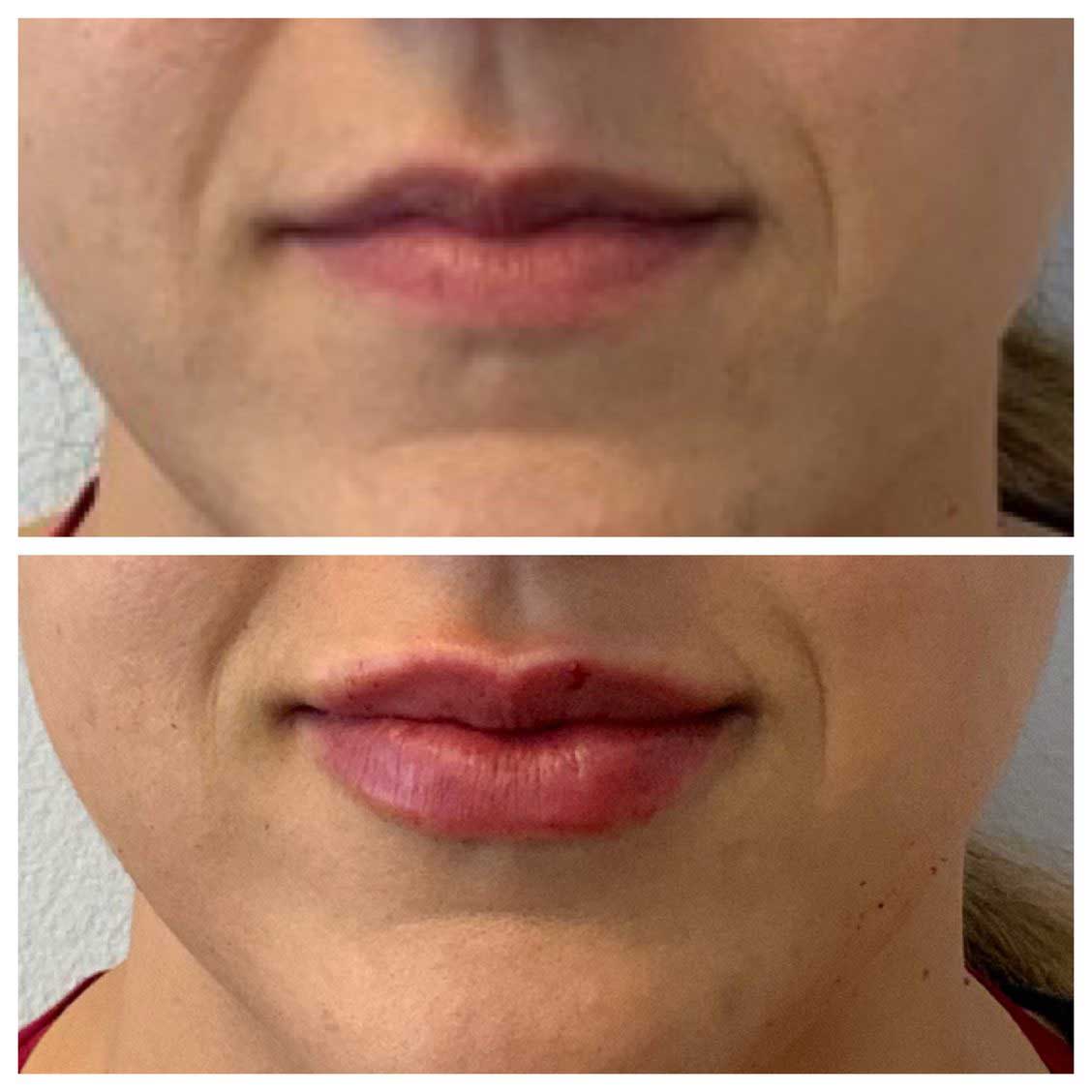 Lip Filler