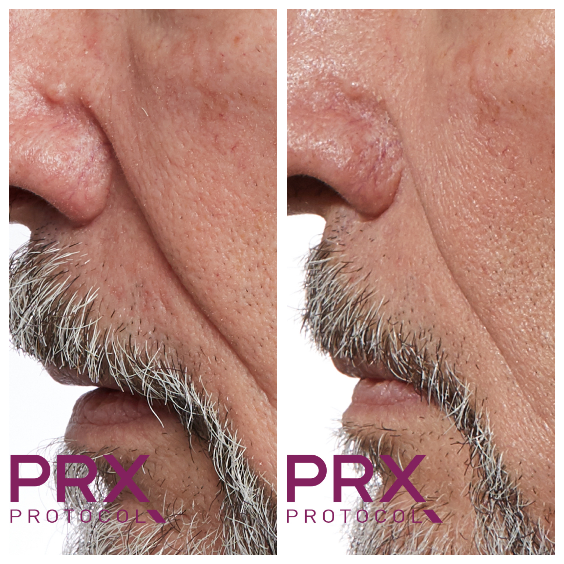 The Dermal Filler treatment