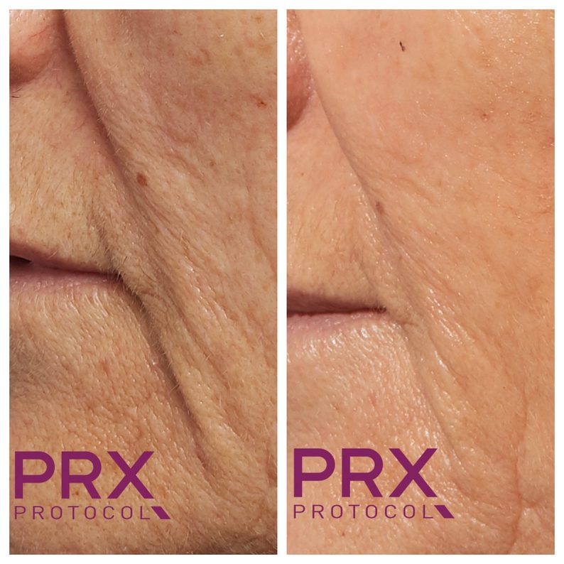 The Dermal Filler treatment