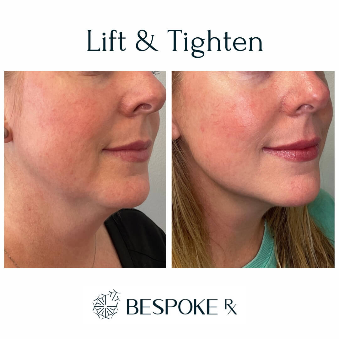 Lift and Tighten