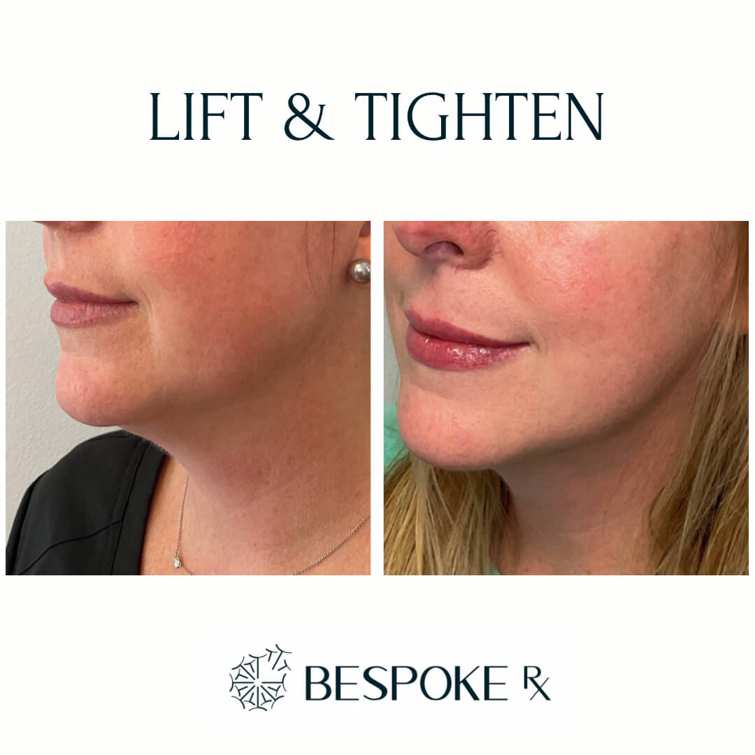 Lift and Tighten