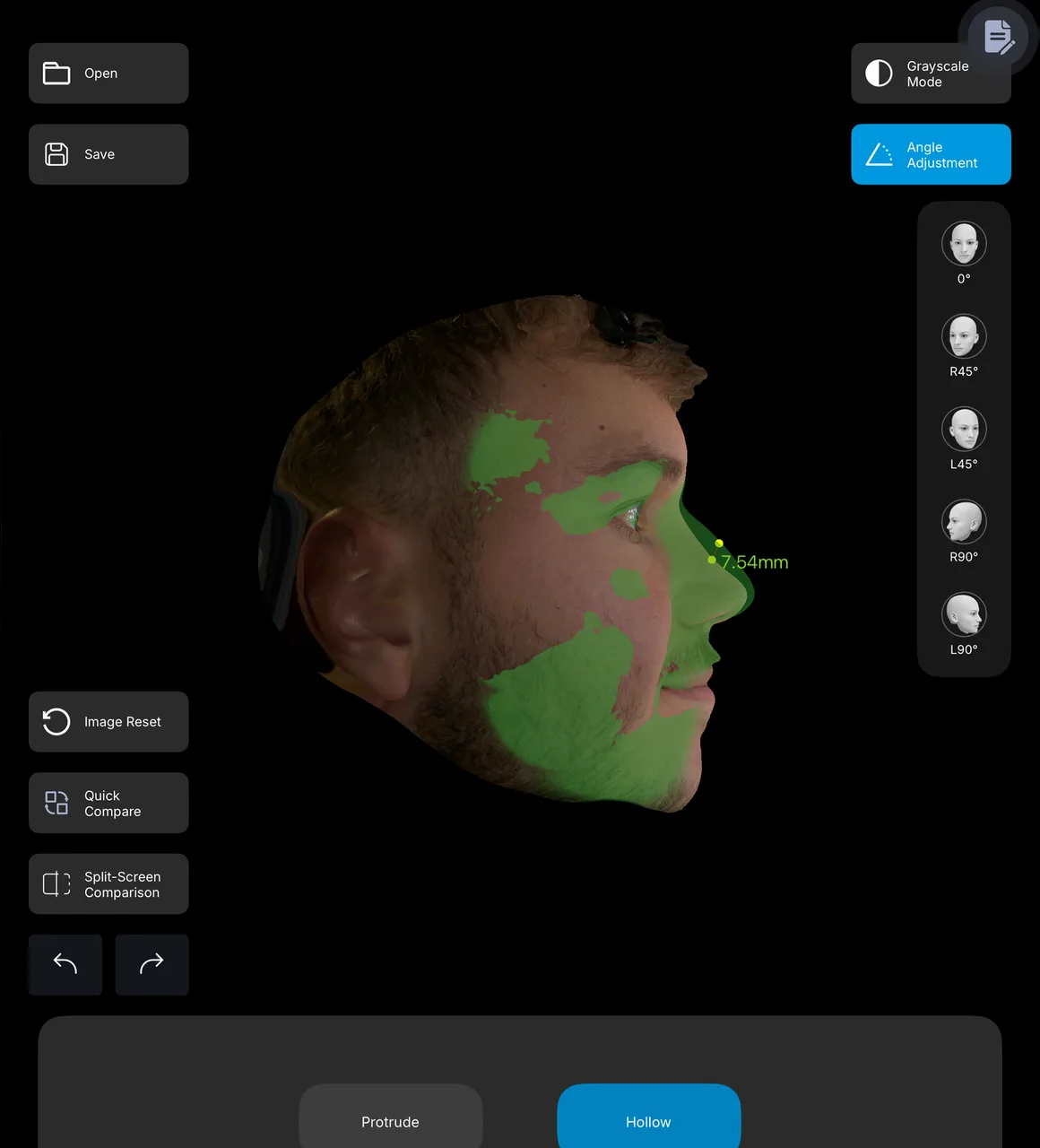 Male profile with green rhinoplasty design overlay and proposed 7.54 millimeter bridge change