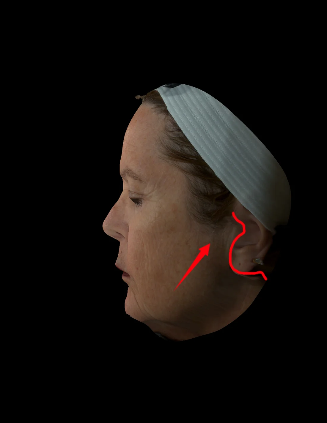 EVA Mark surgeon-drawn lift vector and periauricular boundary on a three-dimensional patient profile