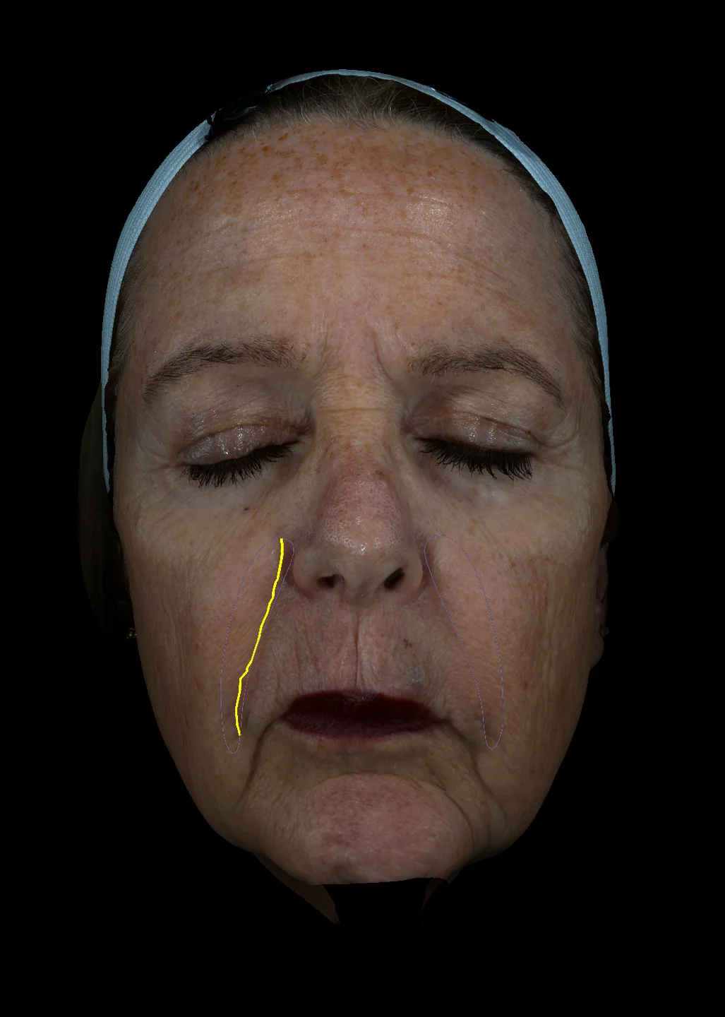 Automated nasolabial fold and wrinkle analysis overlay