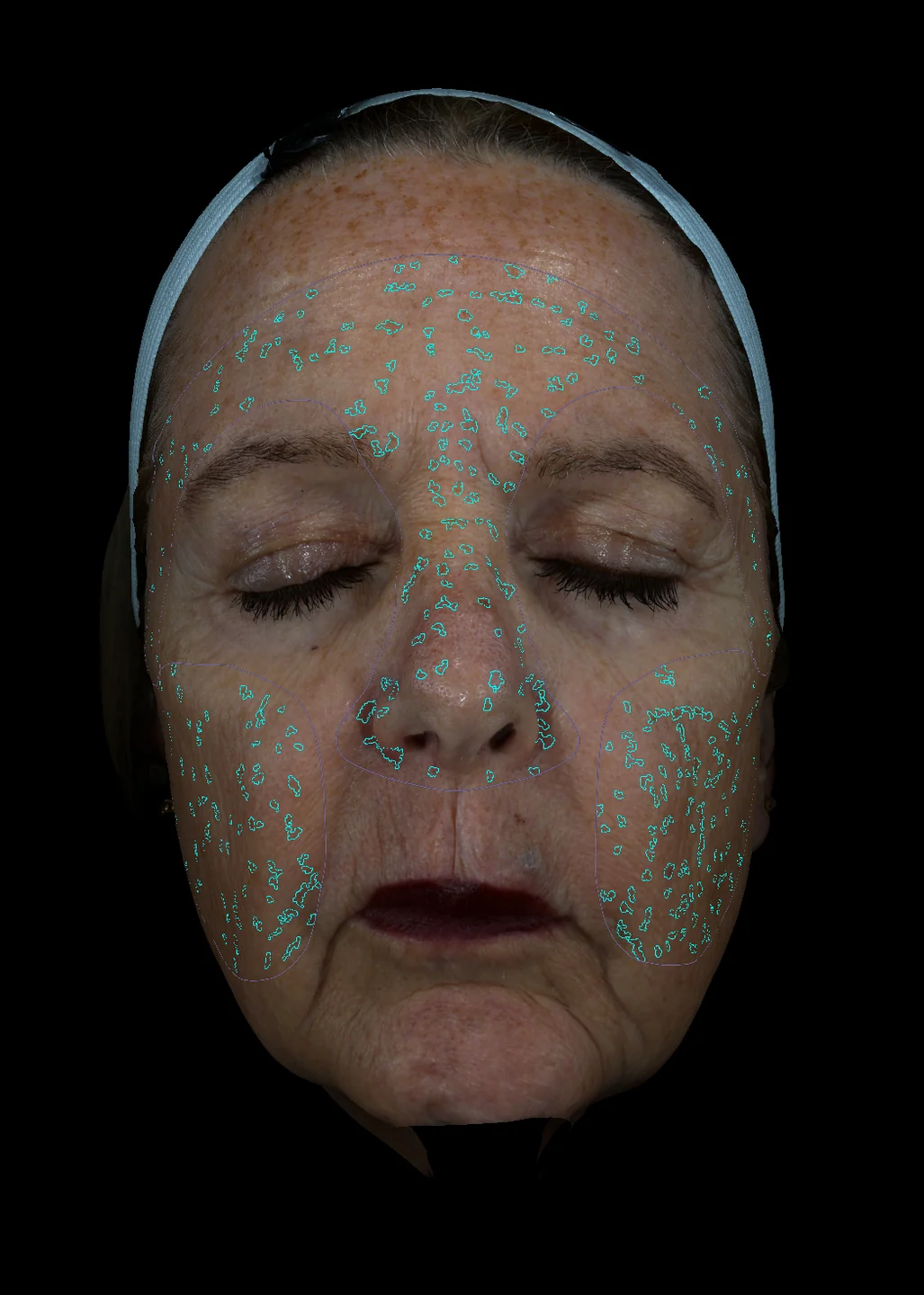 Automated erythema and sensitivity analysis overlay
