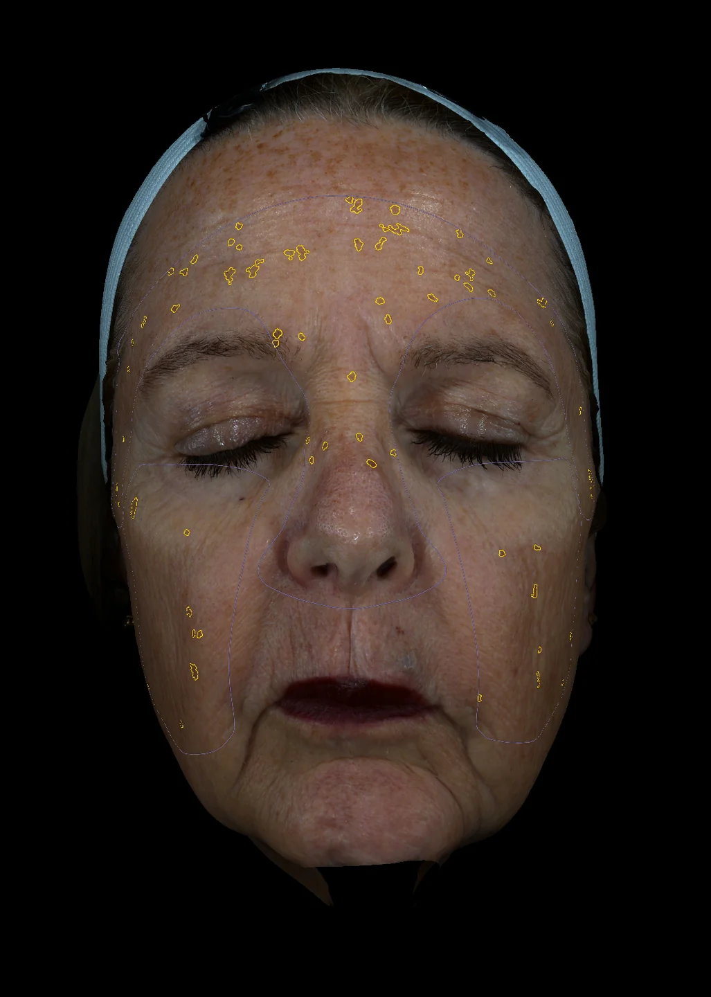 Automated hyperpigmentation and spot analysis overlay
