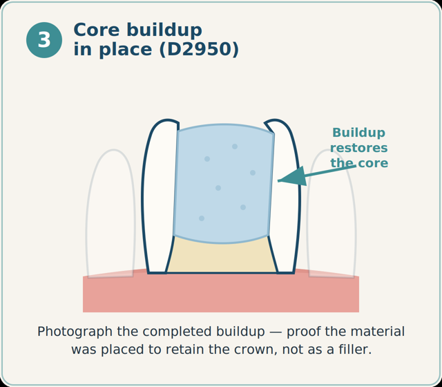 Core buildup material placed, rebuilding the missing structure.
