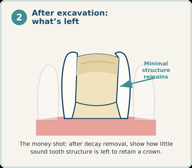 After excavation: minimal sound tooth structure remains.
