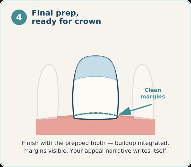 Final crown prep with the buildup integrated and clean margins.