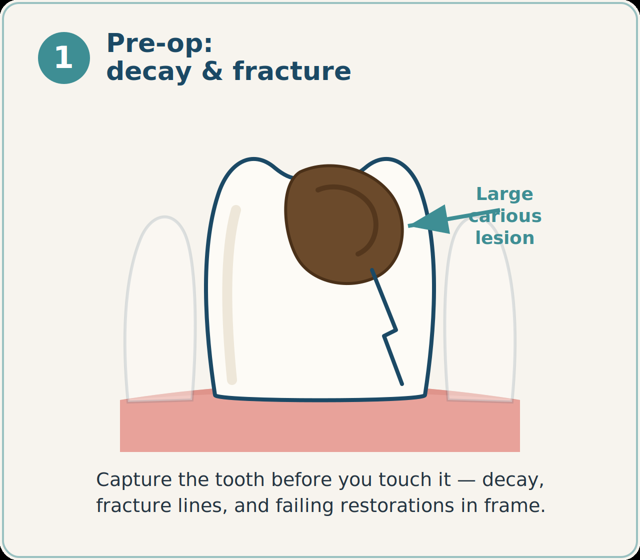 Pre-op: tooth with a large carious lesion and fracture line.