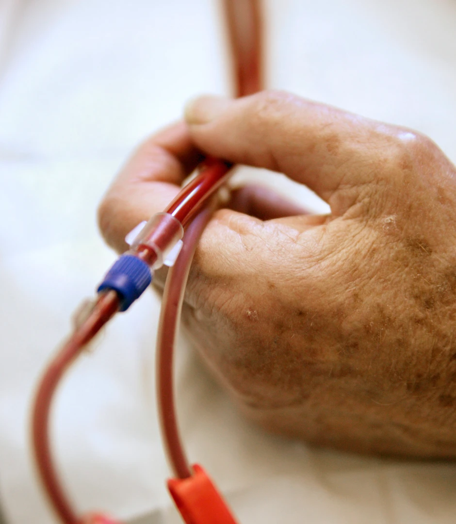 Close-up of a patient holding blood-filled dialysis tubing.