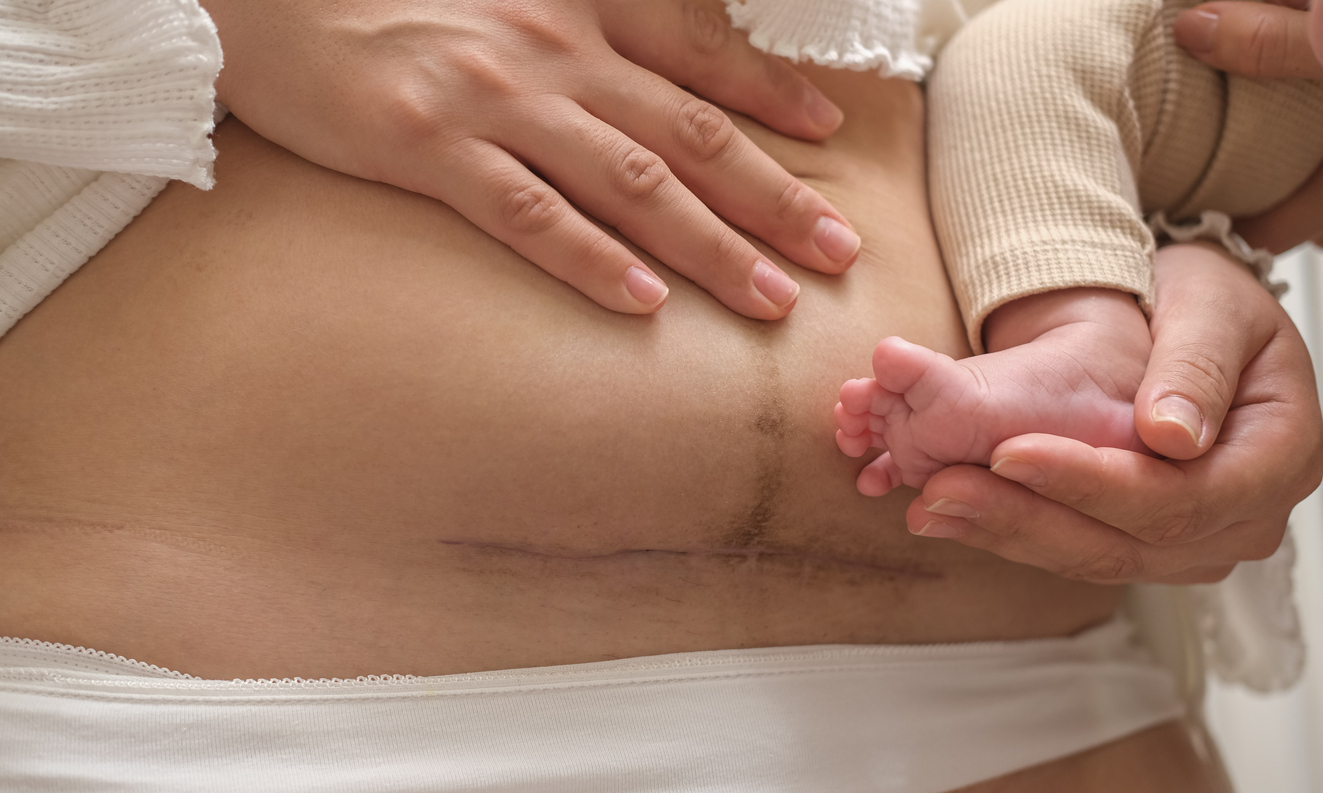 Close-up of a mother's abdomen showing a healed Cesarean section scar as she gently holds her baby's foot.