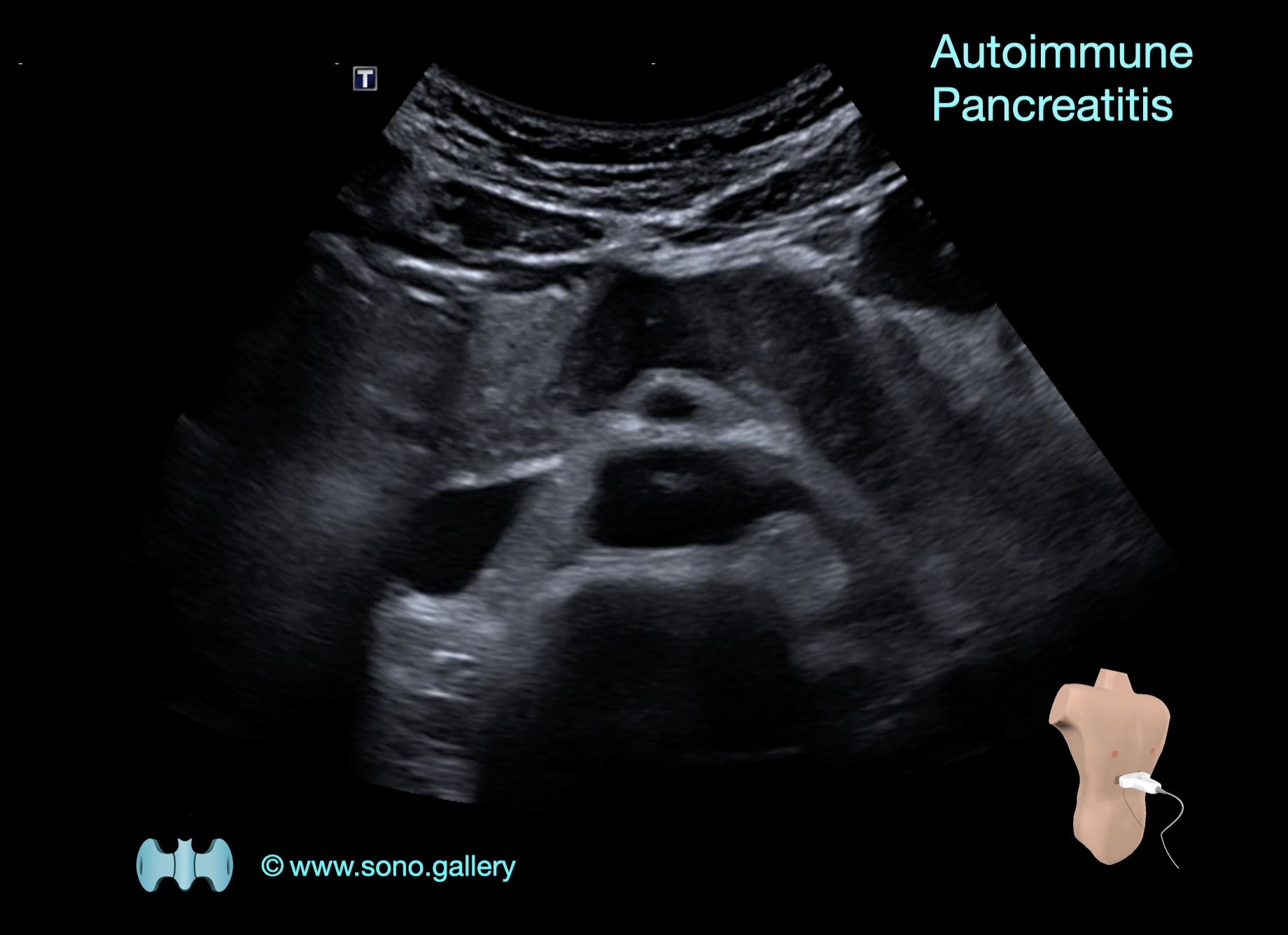 Autoimmune Pancreatitis