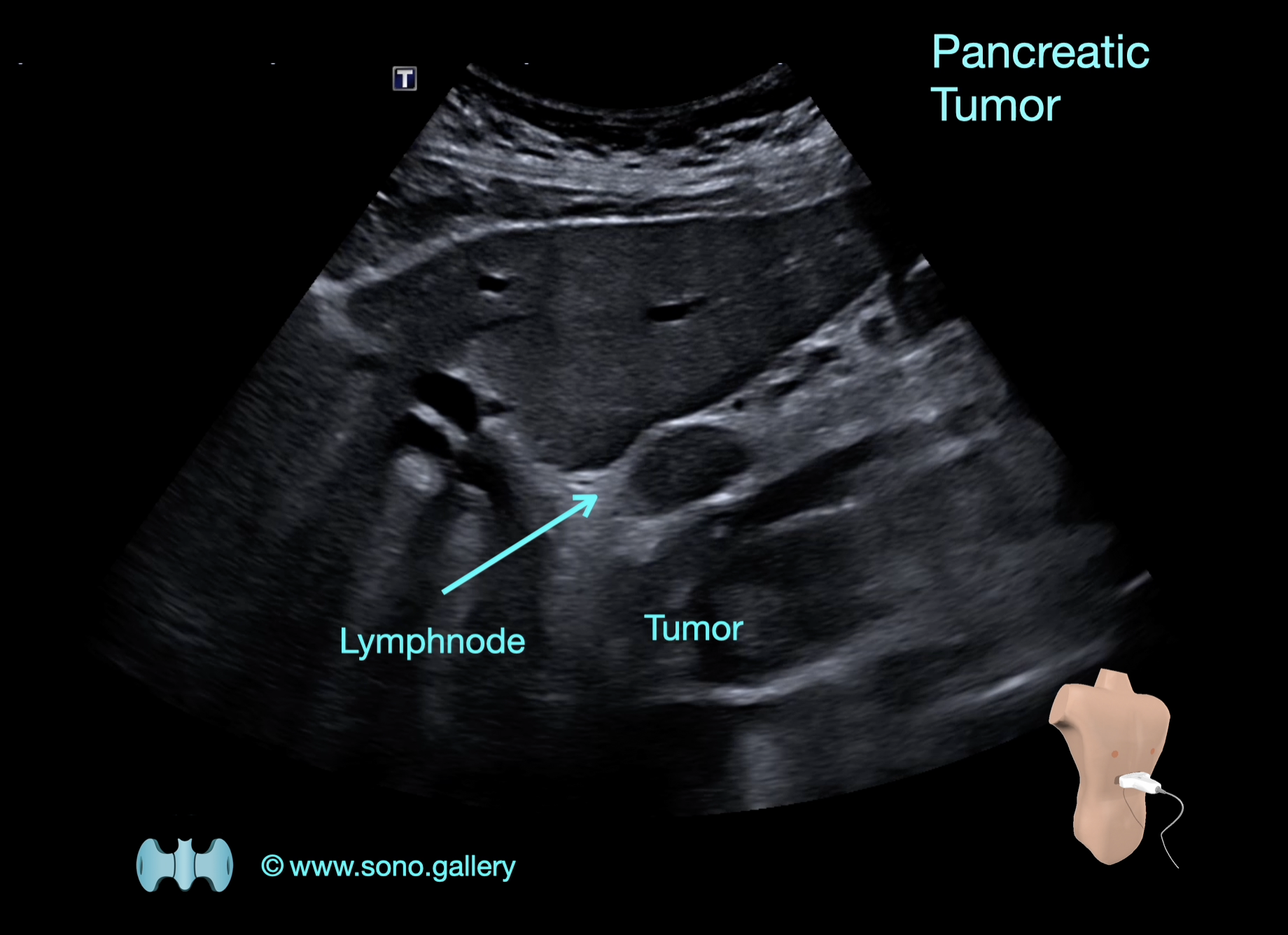 Pancreatic Tumor