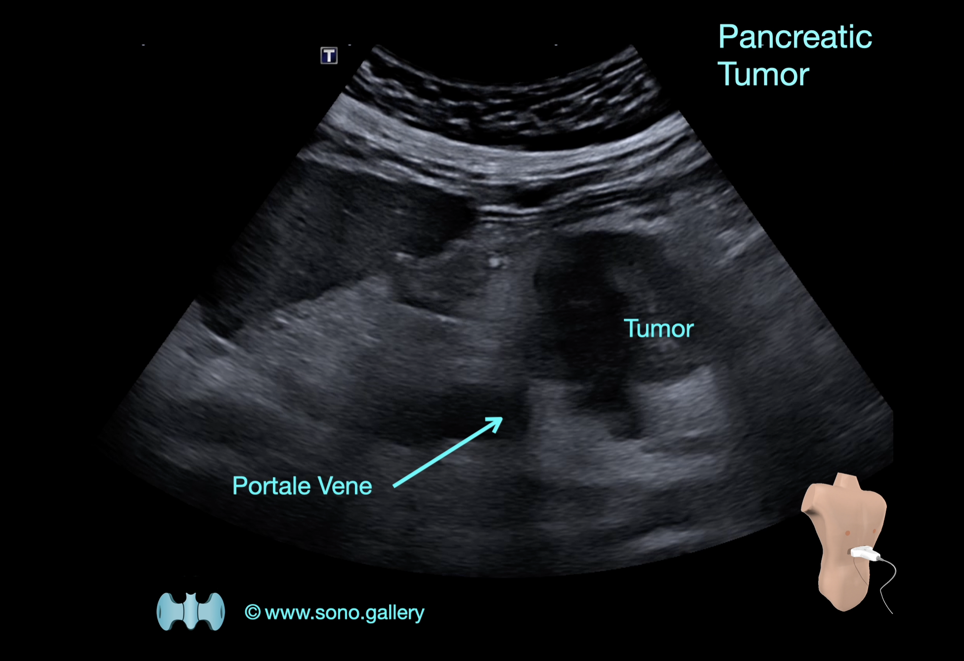 Pancreatic Tumor