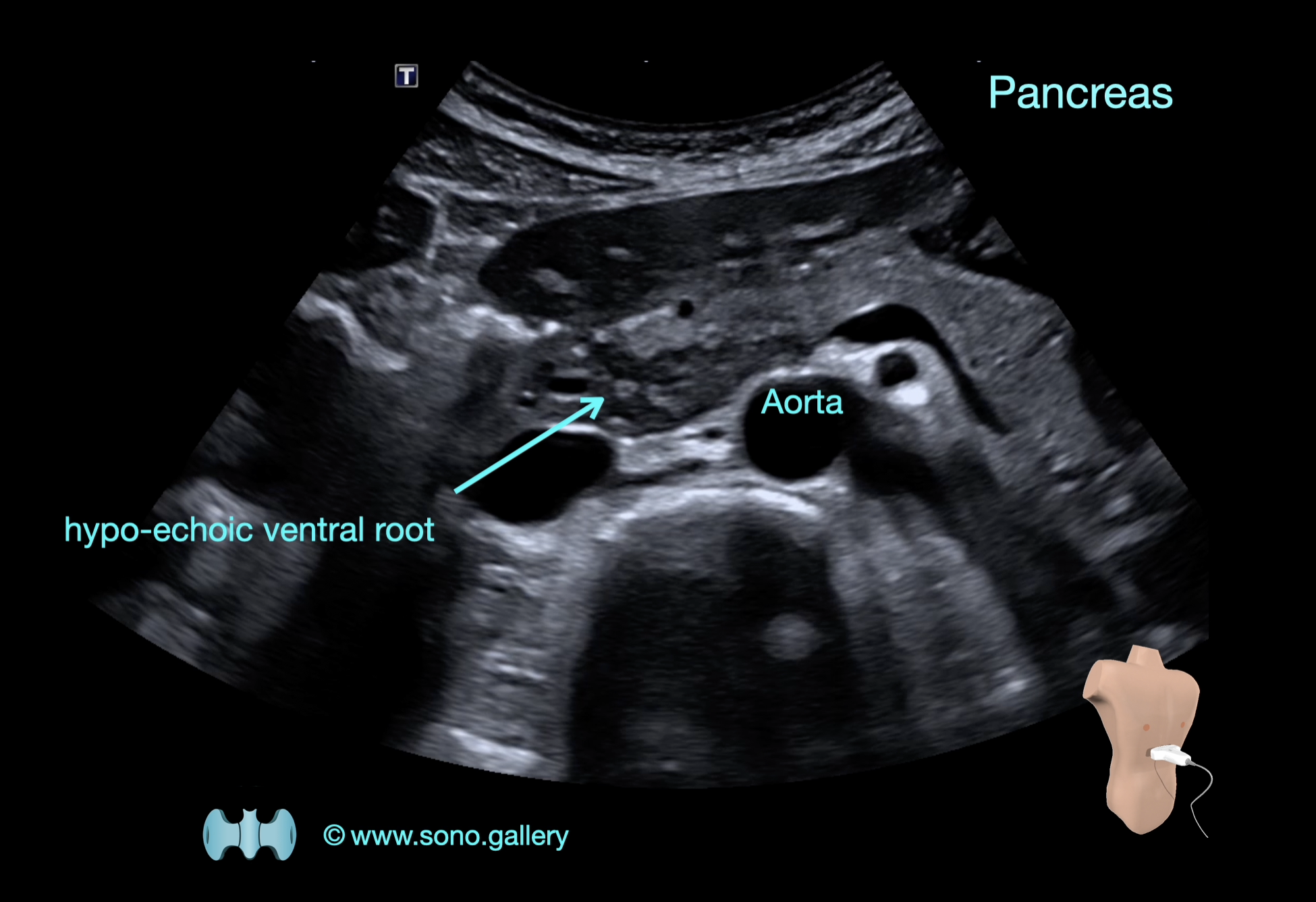 Pancreas