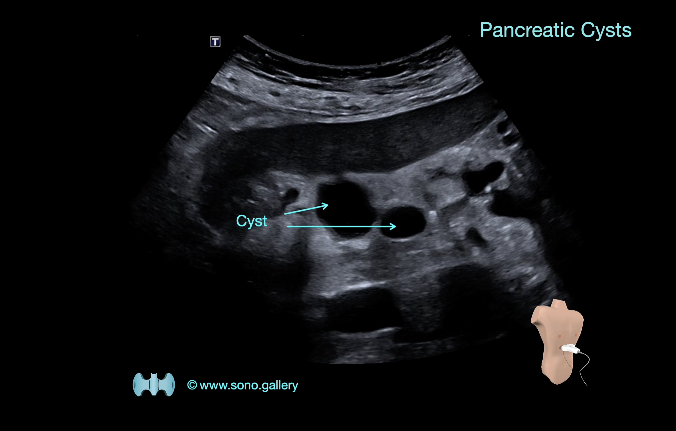 Pancreatic Cysts