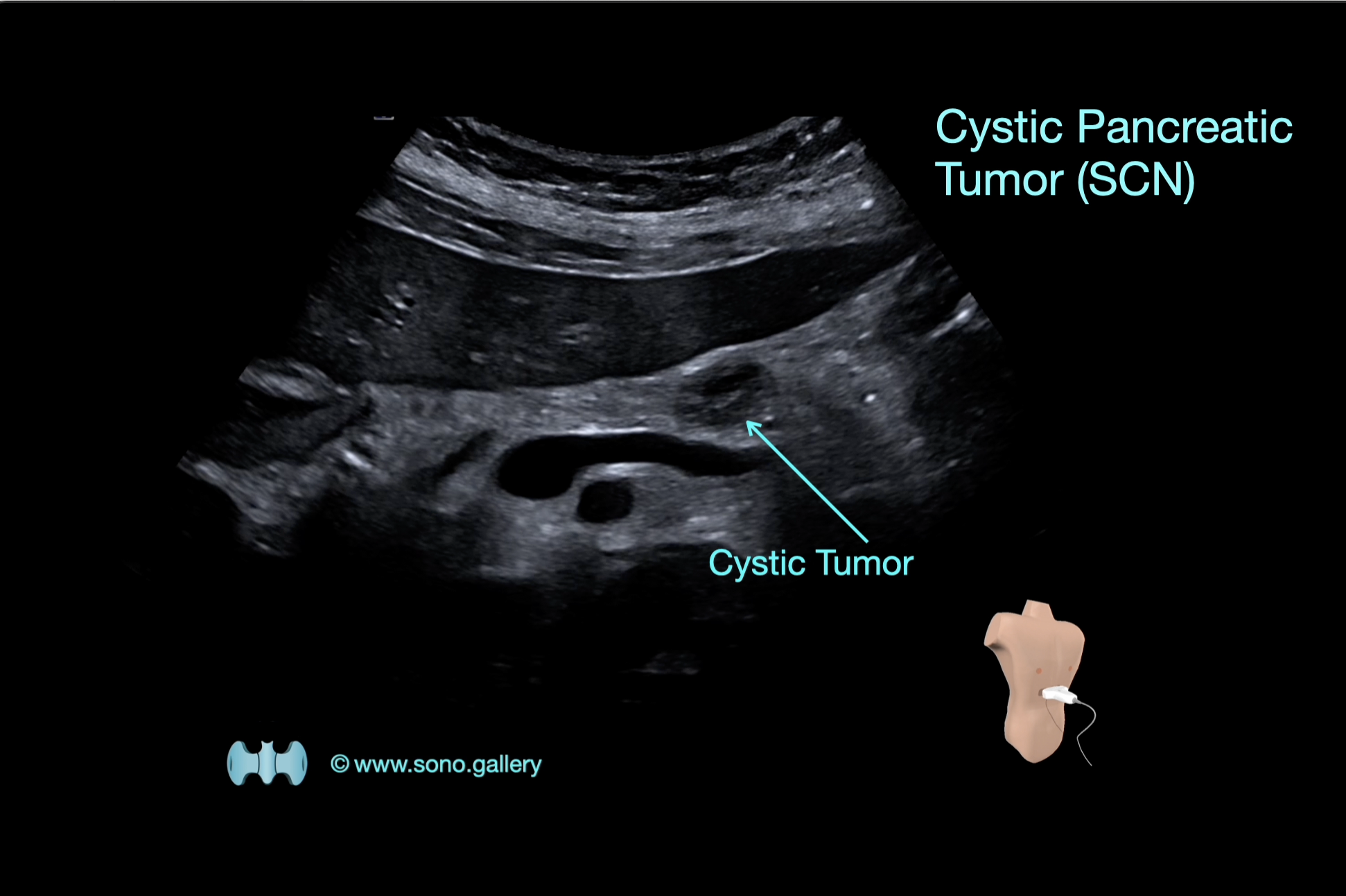 Cystic Pancreatic Tumor (SCN)