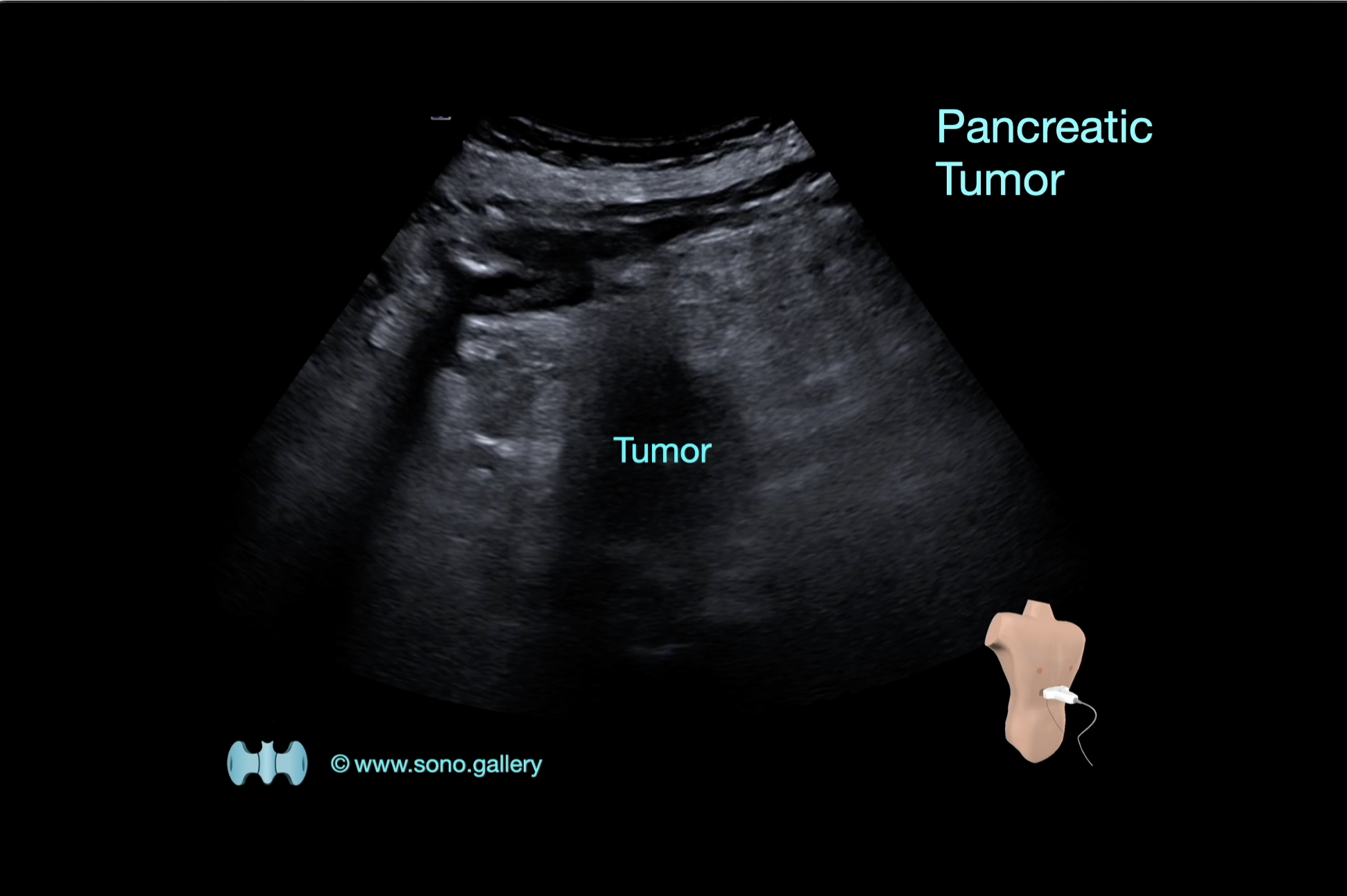 Pancreatic Tumor