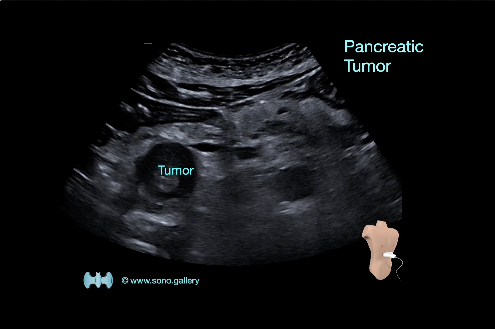 Pancreatic Tumor