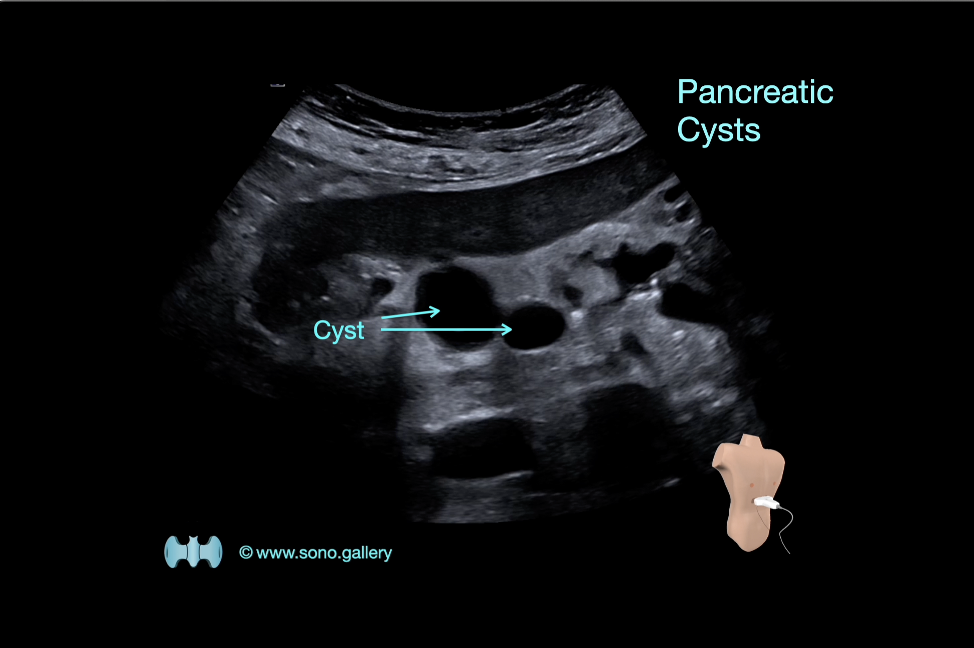 Pancreatic Cysts