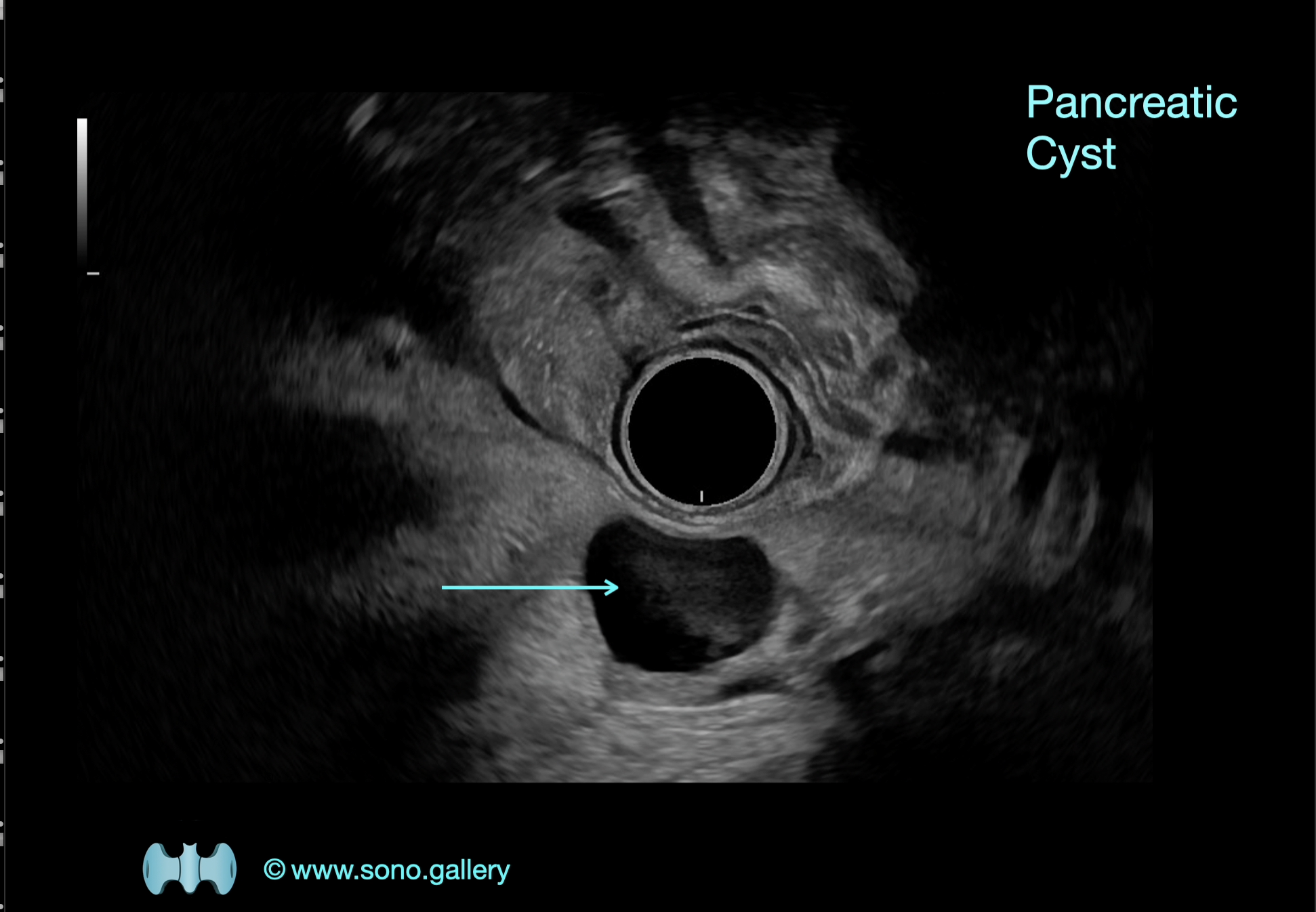 Pancreatic Cyst