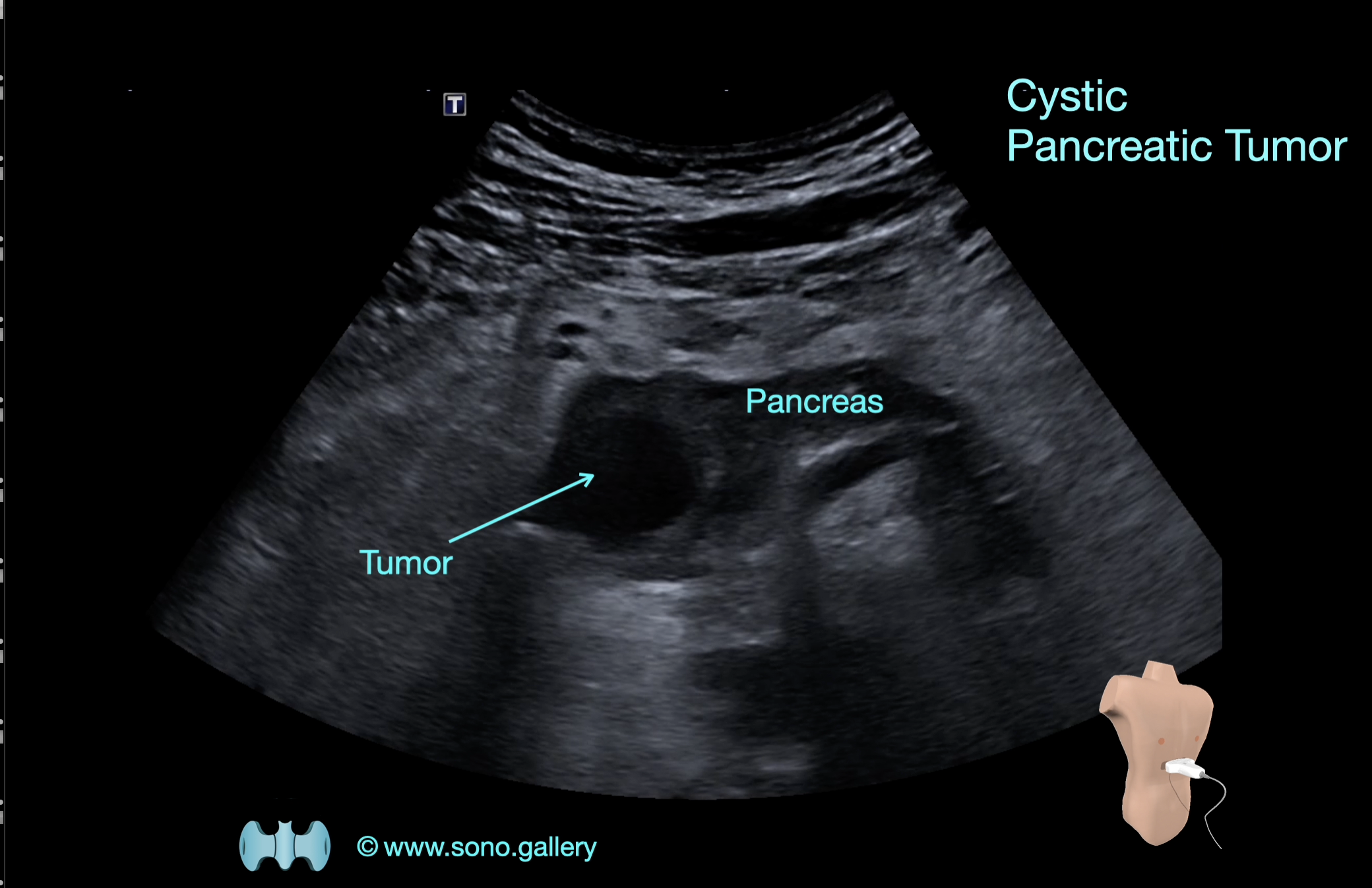Cystic Pancreatic Tumor