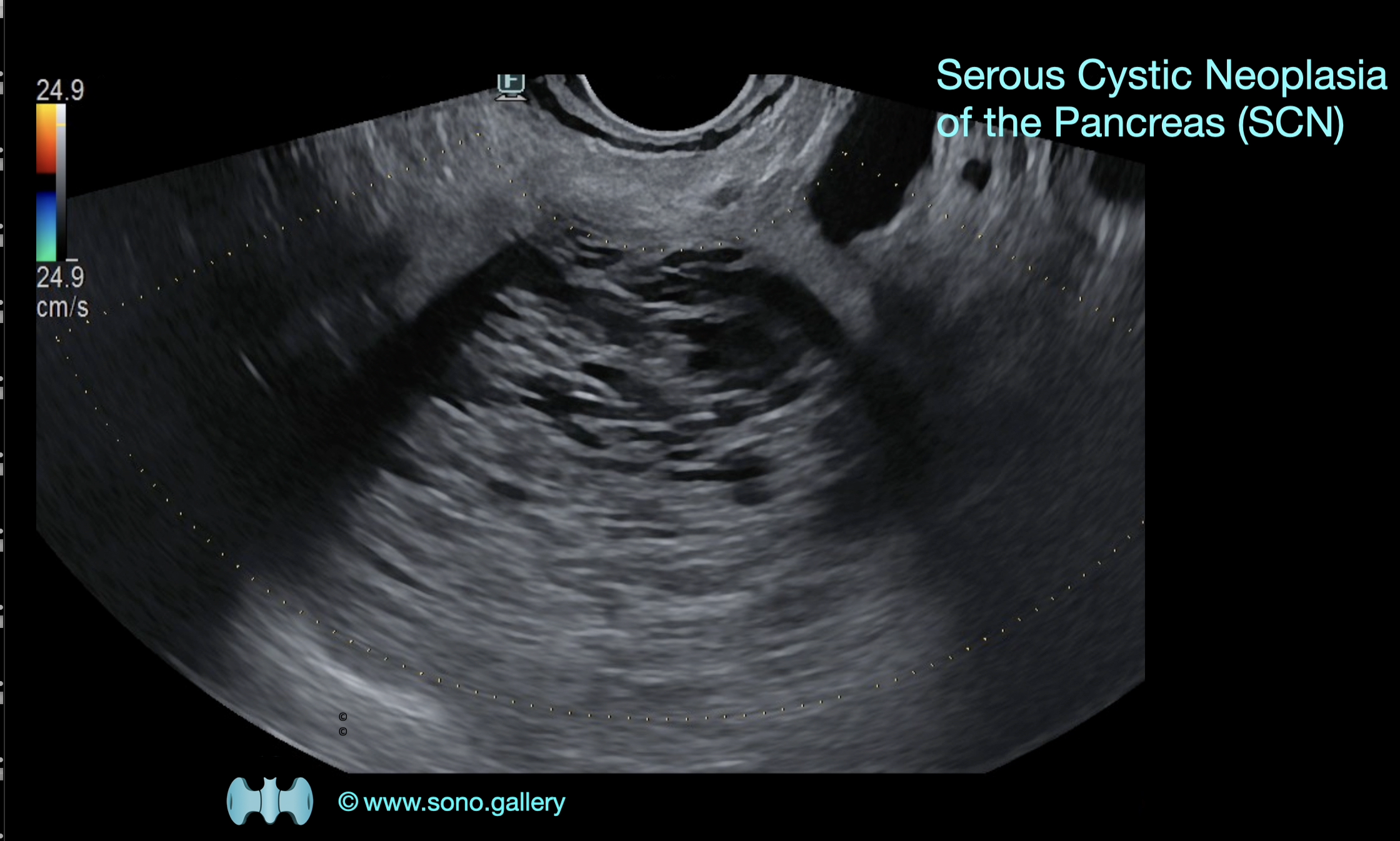 Serous Cystic Neoplasia of the Pancreas (SCN)