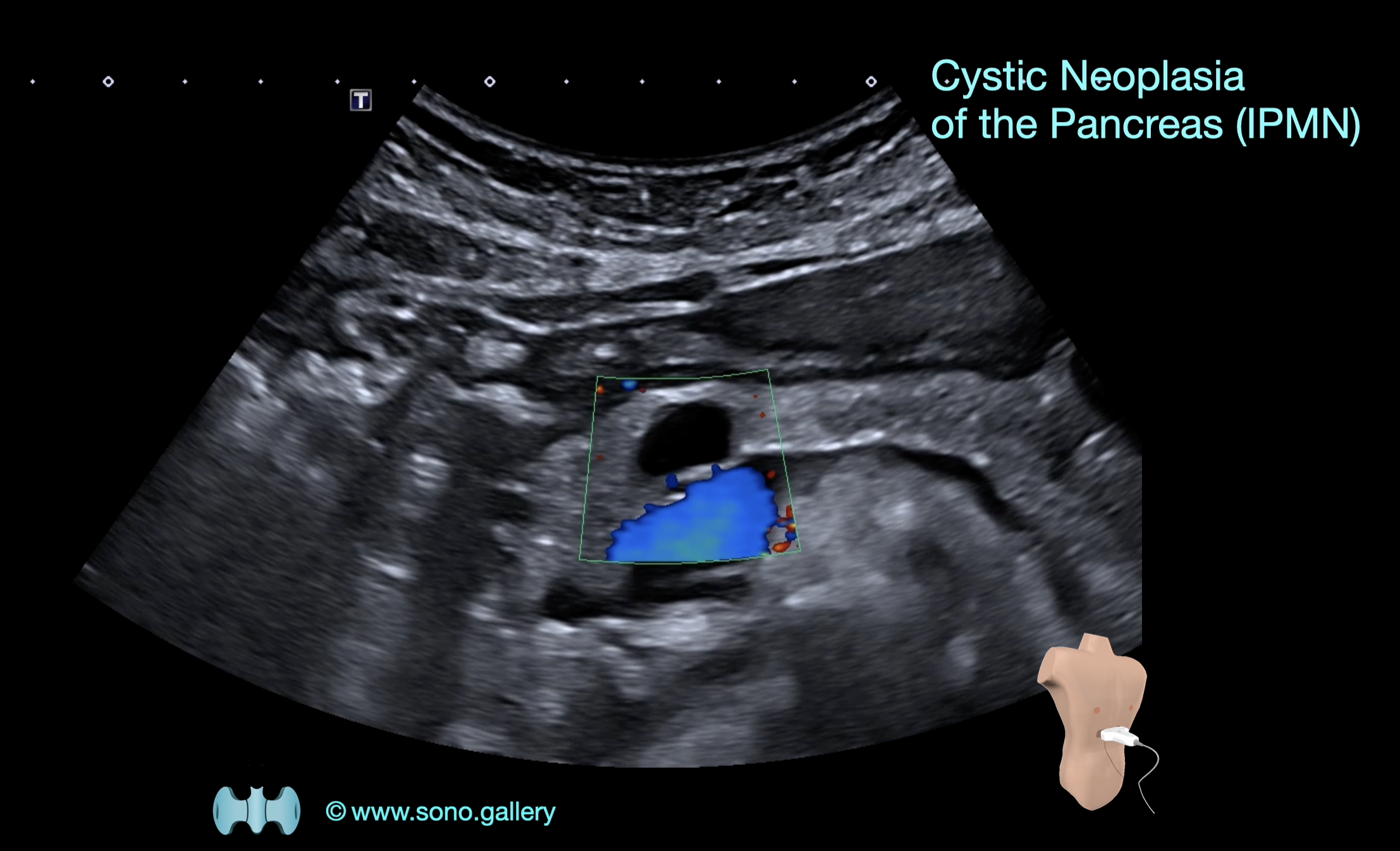Cystic Neoplasia of the Pancreas (IPMN)