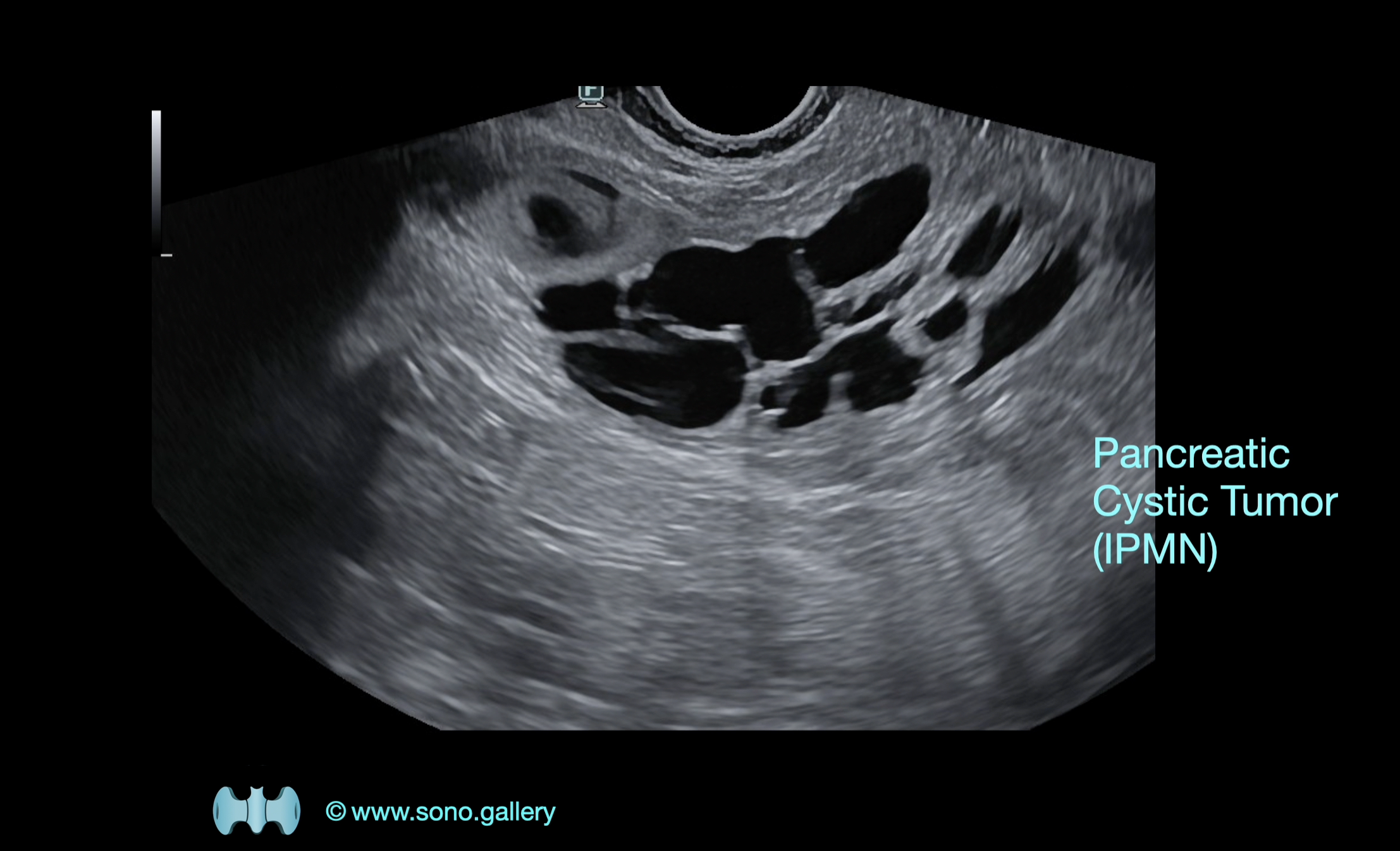 Cystic Tumor of the Pancreas (IPMN)