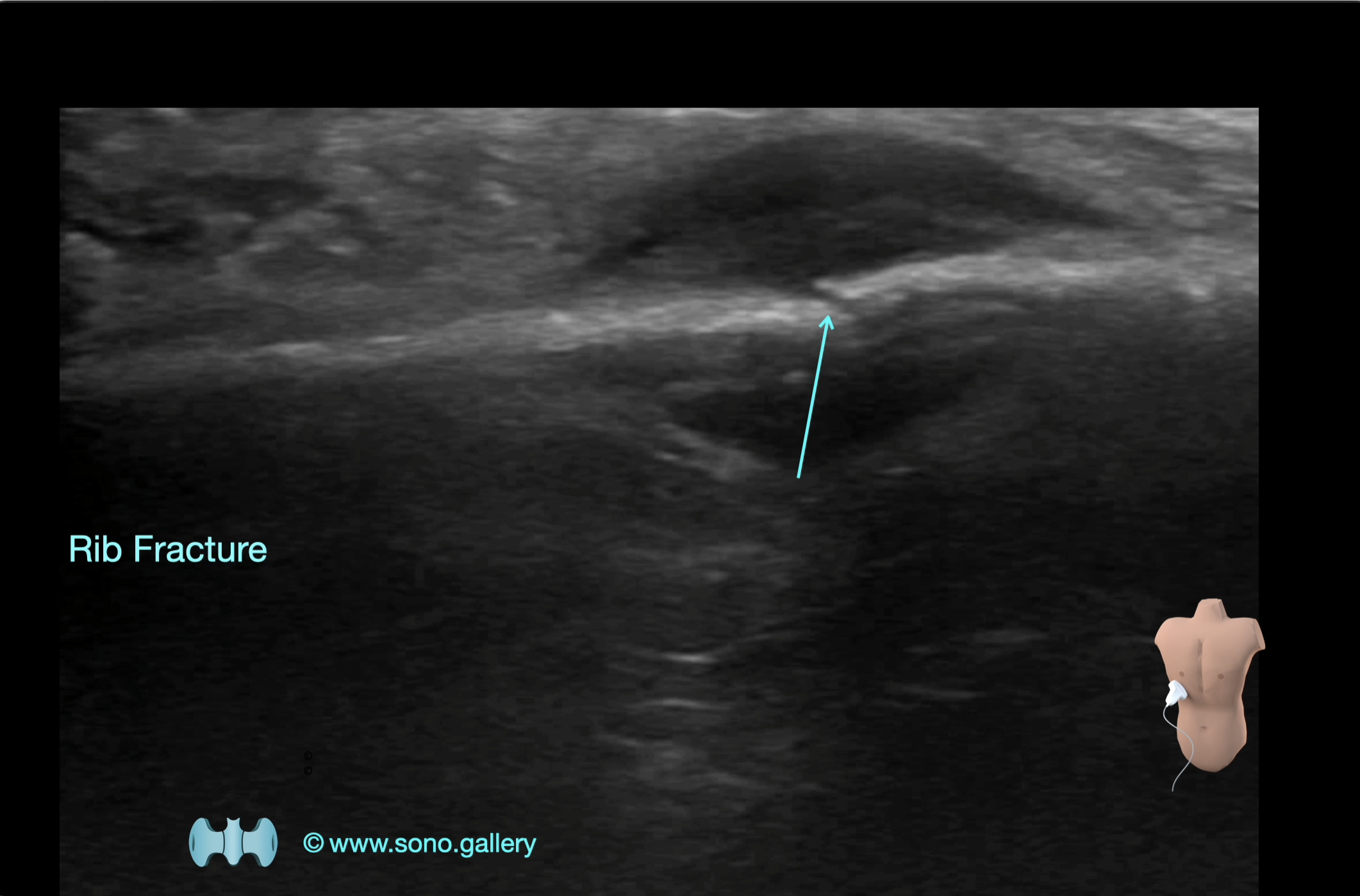 Rib Fracture