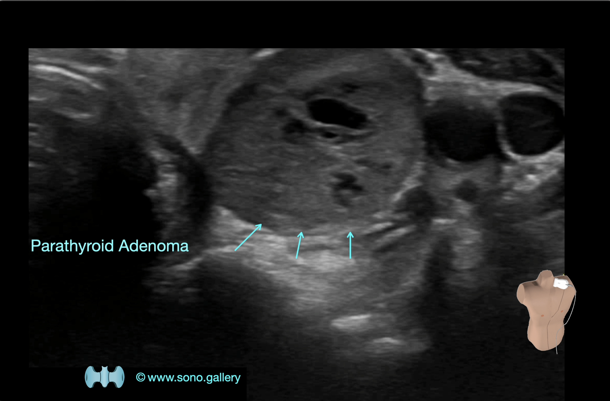 Parathyroid Adenoma